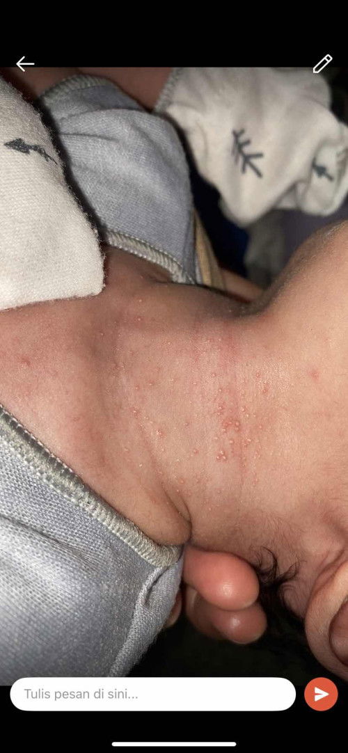 Bintik merah di leher bayi