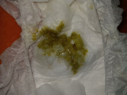 ขอสอบถามหน่อยค่ะอุจจาระลูกมีสีเขียวปนเหลืองมีมูกกับเลือดเล็กน้อยอันตรายมั้ยลูกกินนมแม่ล้วน100%