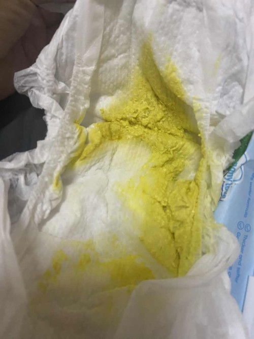 สีอุจจาระ ปกติไหม