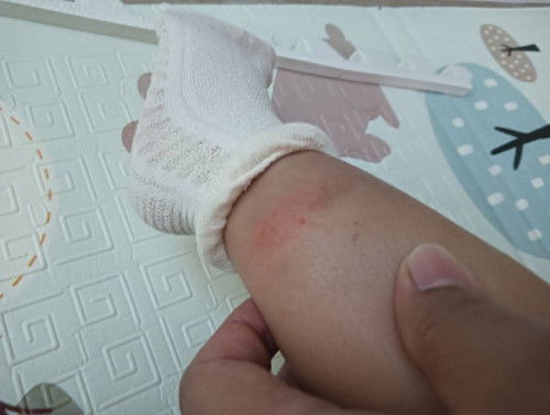 เบบี้โดนยุงกัด