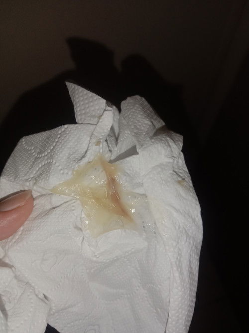 Good evening po normal po ba ito sa 1st trimester?
2months na po akong buntis..