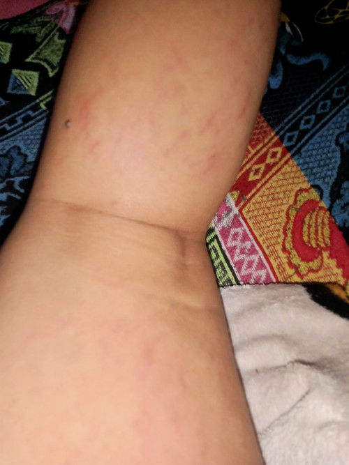 Bunda ini strectmark apa varises?