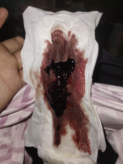 pagdurugo! baka po may same case tulad sakin🥺