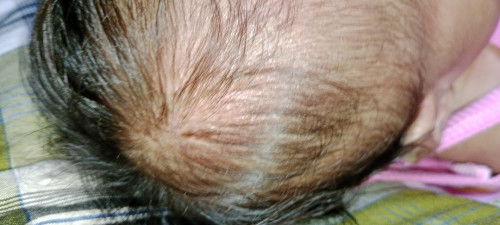 Cara ngatasin bintik² merah kepala bayi, solusinya dong bund