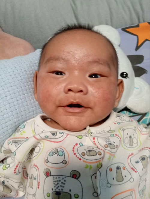 หน้าเป็นผื่นแดง