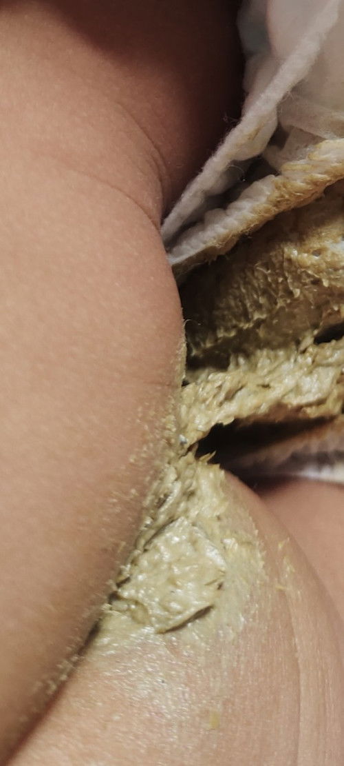 อุจจาระลูกสีแปลก