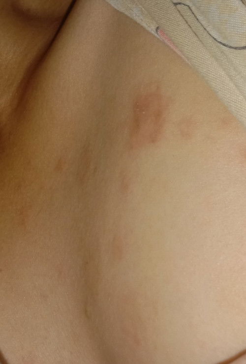 Gatal kemerahan bulat seperti kurap TPI bukan kurap