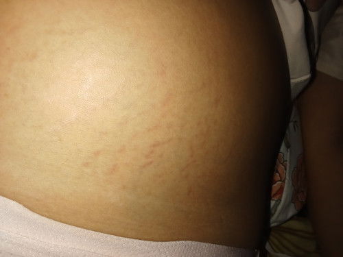 Plr terpaksa harus lahir di 30 minggu