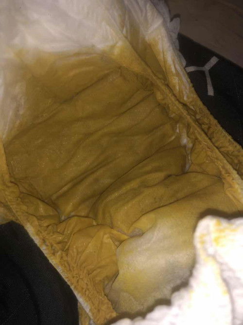 ลูกอึแบบนี้ปกติไหมคะแม่ๆ