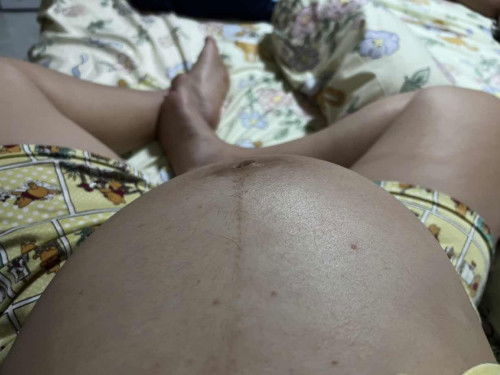 แชร์ประสบการณ์คลอด 37+4 ปากมดลูกเปิด 6 เซน ไม่รู้เรื่อง 
และรกพันคอ 1 รอบ