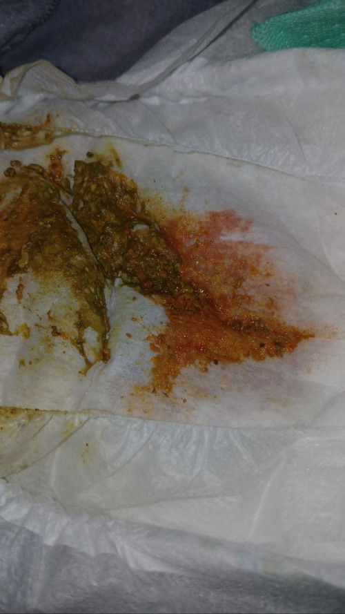 ทารกได้26วัน ท้องเสียแล้วหาหมอมาแล้ว