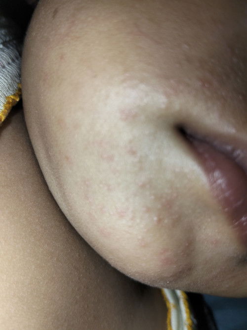 Bintik merah di pipi , jidat  di sertai demam bayi 8bulan. Ini kira" kenapa ya Bun..