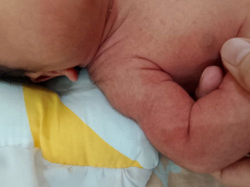 Mga mi may same case ba sa baby ko nagkaron ng ganto sa katawan, 13days old palang sya. FTM po ako.