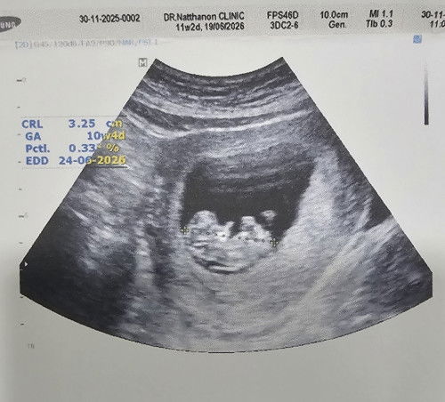 ทีมคุณแม่ตั้งท้อง 2 คลอดเดือนมิถุนา 69 คะ