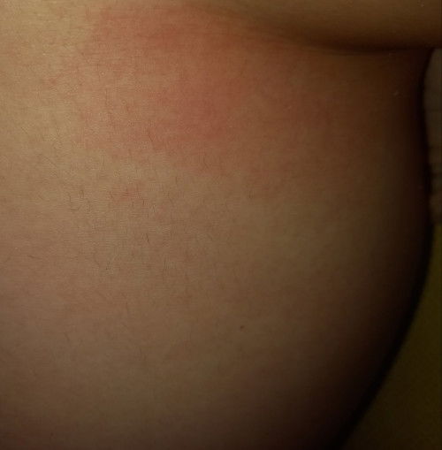 Mahapdi sa ilalim ng boobs