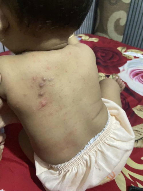 bentol di punggung bayi 8 bulan