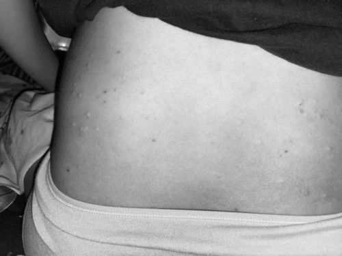 Safe ba ipahid sa tyan ang calmoseptine?