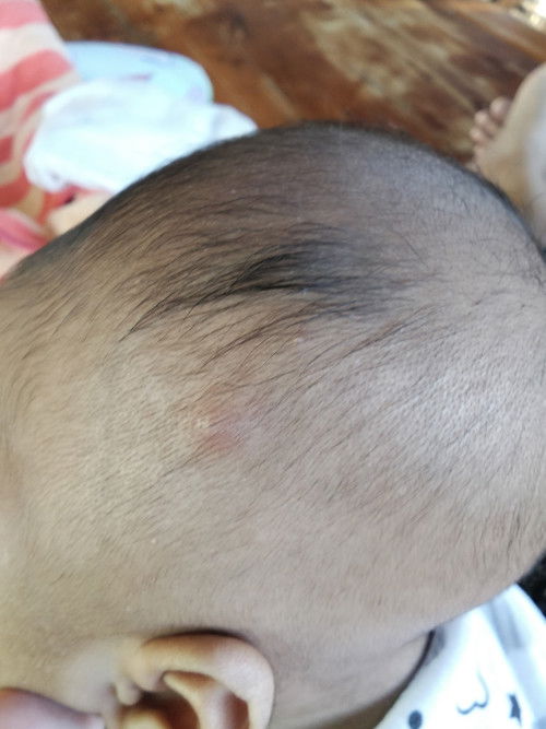 น้องมีตุ่มบนหัว