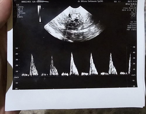 Ada yang pernah dapat suntik pengencer darah pas hamil?