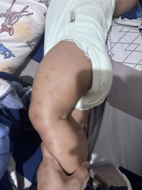 Bekas menghitam karena gigitan semut dan nyamuk