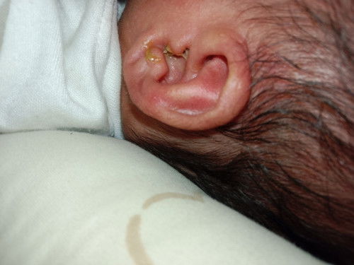 Keluar Cairan kental kuning dari telinga