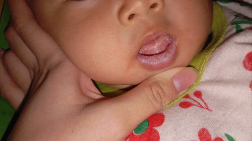 Jamur dan sariawan pada anak