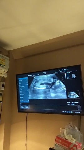 ภาพอัลตร้าชาวด์