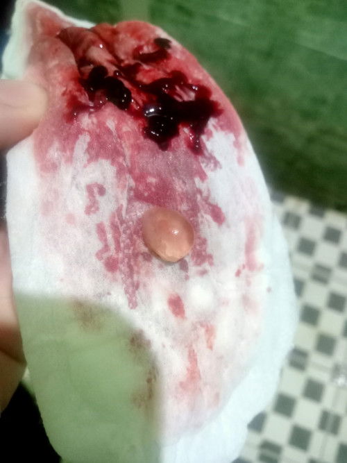 Keguguran berkedok flek