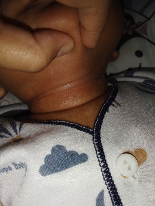 Bun anak aku di lehernya ada putih putih kaya panu gituh kenapa yah ada yang tau cara nyembuhinnya g