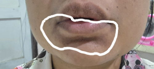 มีผดคัน ออกสีดำขึ้นที่หน้า