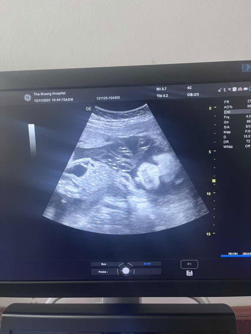 ช่วยดูรูปอัลตราซาวด์หน่อยค่ะ
