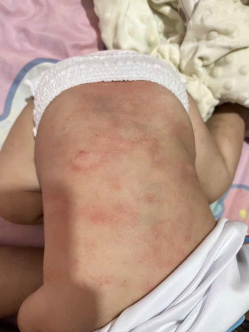 ผื่นแบบนี้คือผื่นอะไรคะ