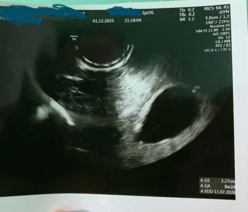 Usg transvaginal 8 minggu belum ada janin