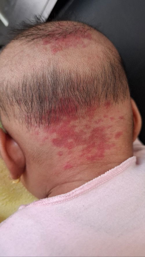 Bercak merah di tengkuk leher dan kepala