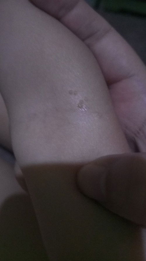 Tumutubo sa balat ng anak ko Anu po kaya to