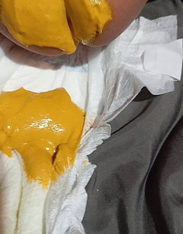 น้องอายุ 2 เดือนกินนมแม่และเสริมนมผง