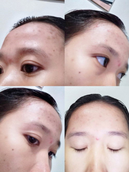 แม่ๆมีตัวไหนแนะนำไหมค่ะท้องสองแพ้แบบนี้ขึ้นแบบนี้เลยท้องแรกไม่เป็น