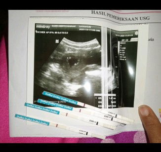 Apakah ini masih hamil soalnya di USG ada kantungnya tapi ditespek garis 1
