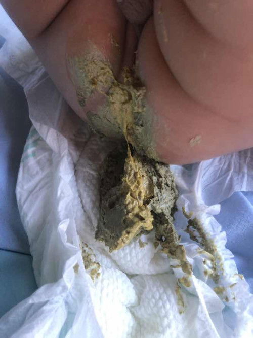 แบบนี้ควนเปลี่ยนนมไม่ค่ะ น้อง3เดือน กินนมผงดูดมัก