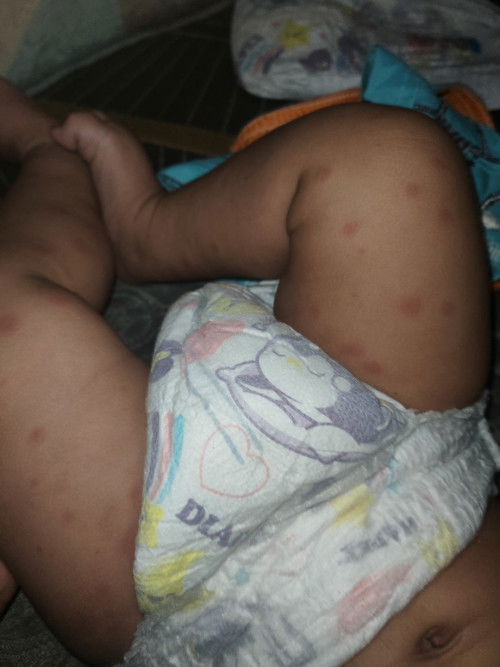 Help mommies, ni alergic food atau chicken pox?