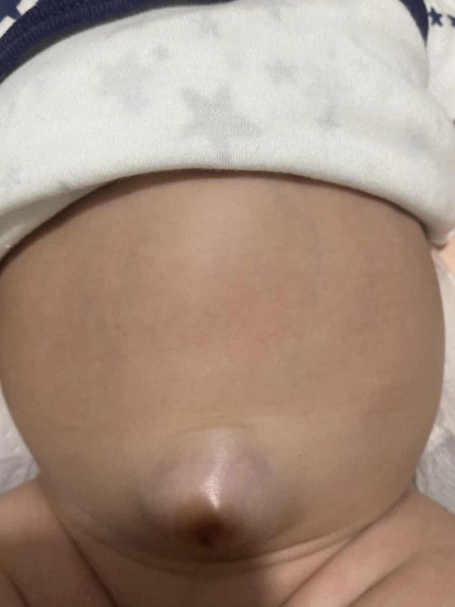 Naka usling pusod ng bata.