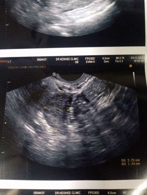 ขอคำปรึกษาค่ะ ท้อง 6 สัปดาห์