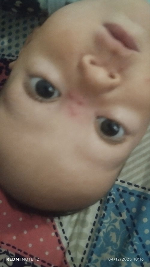 Bintil kecil di muka