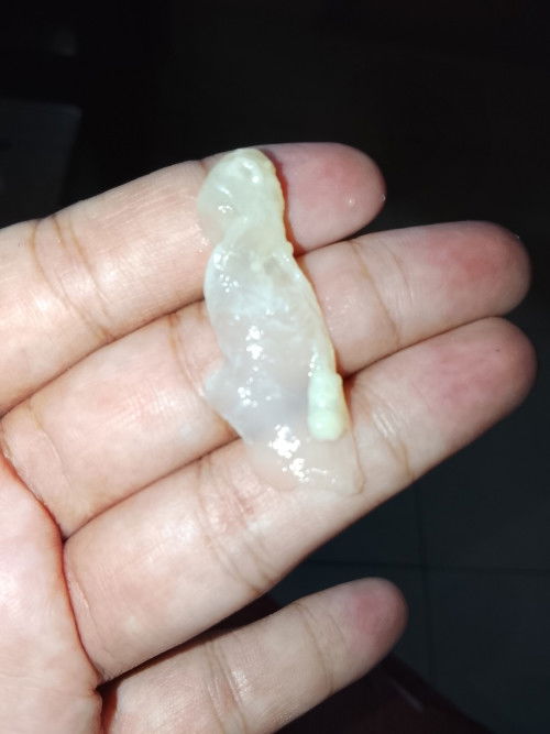 Keluar keputihan seperti jely