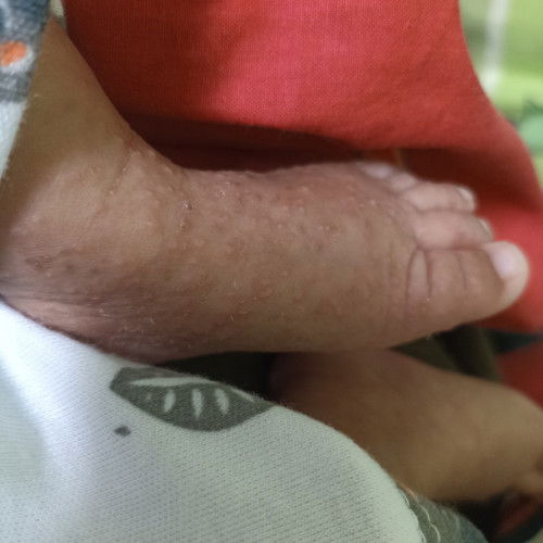 Kulit bayi gatal bruntusan