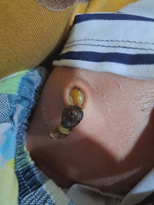 สะดือของลูกปกติมั้ย