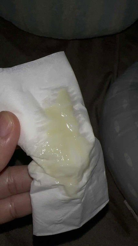 discharge candida overgrowth..