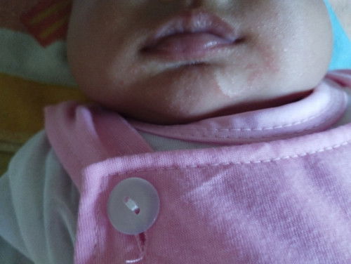 Cara hilangin dan ratain kulit pada bayi karna bekas ruam ASI