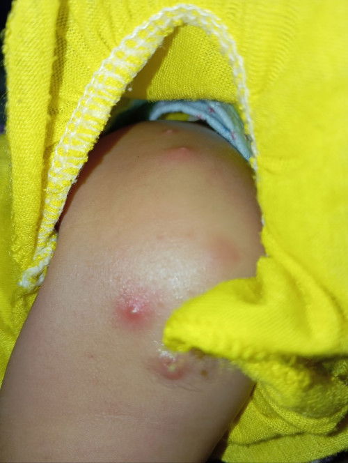 Bisul/biang keringat ya