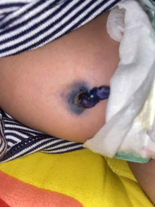 สะดือลูกยังไม่หลุด 24 วัน